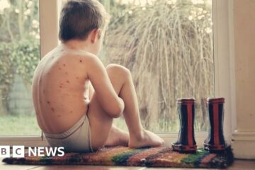 Give toddlers chickenpox jab, advisers tell NHS