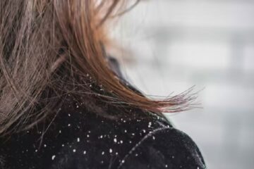 How to Get Rid of Dandruff - SUCH TV