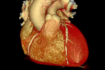 New Gene Editing Treatment Cuts Dangerous Cholesterol in Small Study