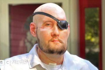 US veteran gets world's first eye transplant