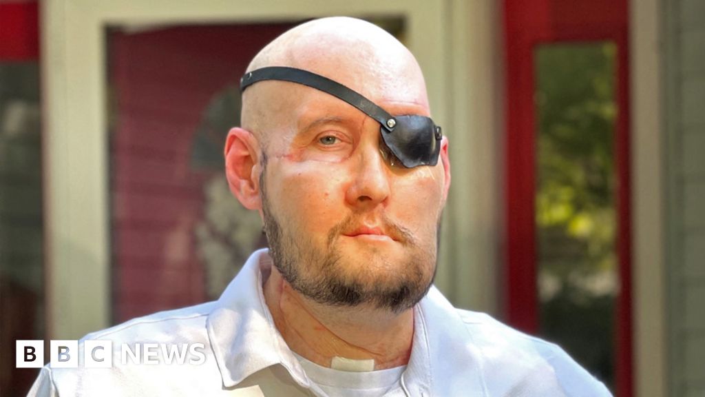 US veteran gets world's first eye transplant