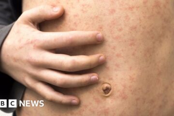 Watch for measles, UK doctors told, as vaccine rate dips