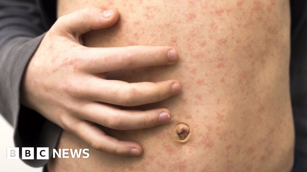 Watch for measles, UK doctors told, as vaccine rate dips