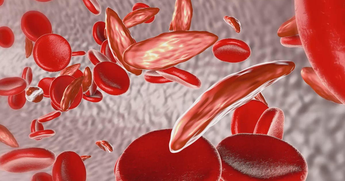 World's first gene therapy for sickle cell and thalassemia approved in the U.K.