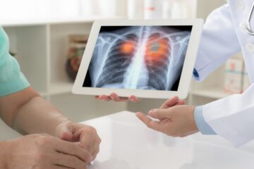 AI model could help predict lung cancer risks in non-smokers, study finds: ‘Significant advancement’