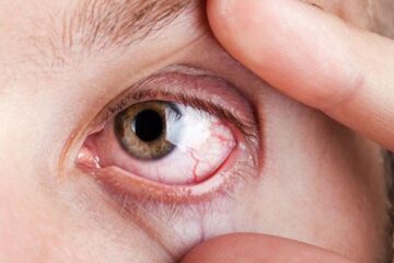 5 untrue chronic dry eye 'facts'