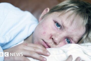 Alarming 30-fold rise in measles in Europe - WHO