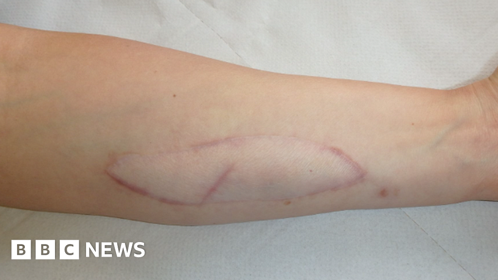 Arm skin patch system could warn of organ rejection