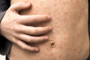 Georgia health officials link third measles case to unvaccinated international traveler